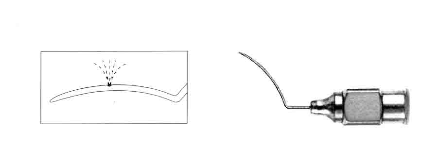 GİMBEL LASİK FOUNTAİN KANÜL
